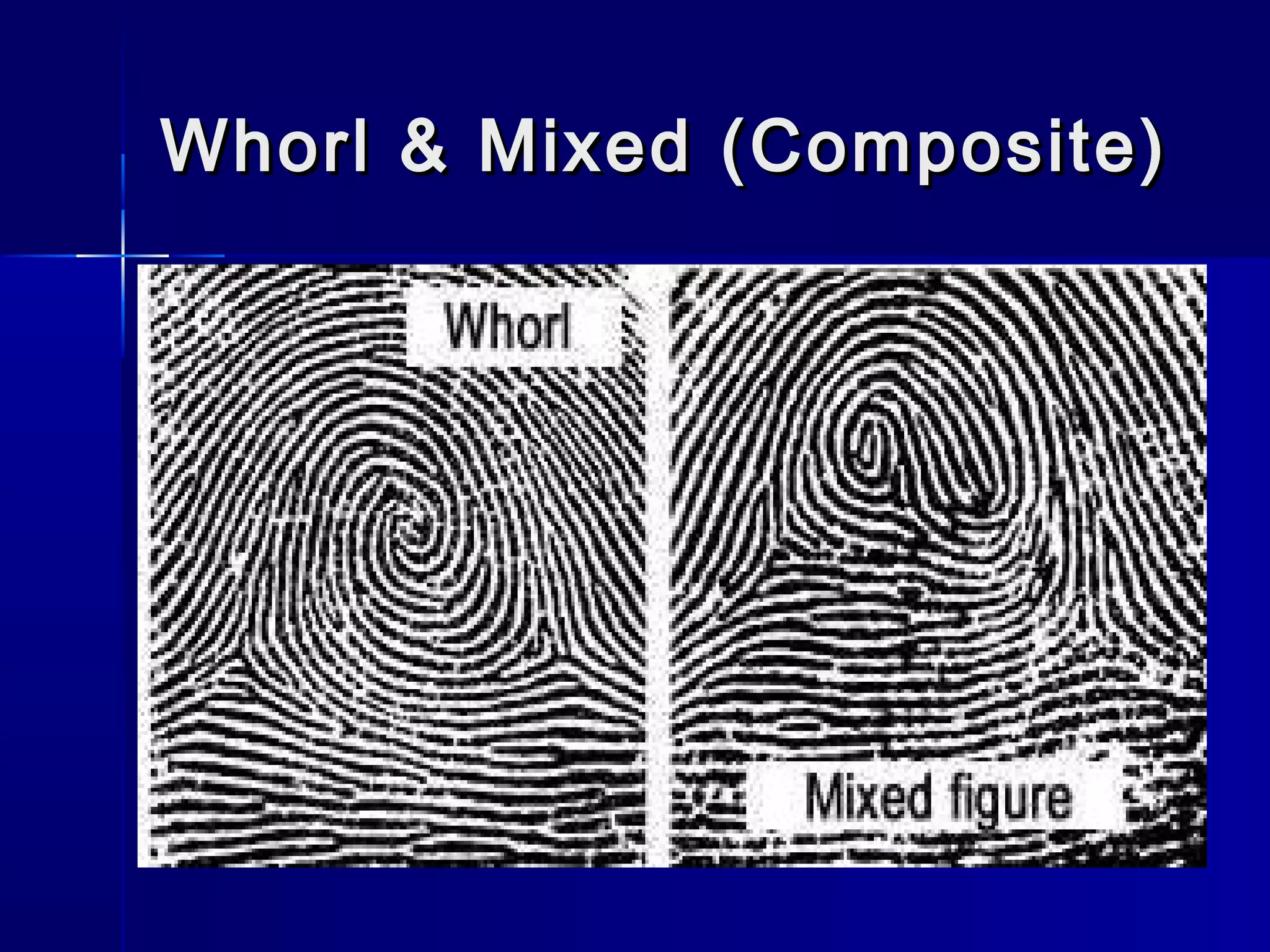 Whorl & Mixed (Composite)Whorl & Mixed (Composite)
 