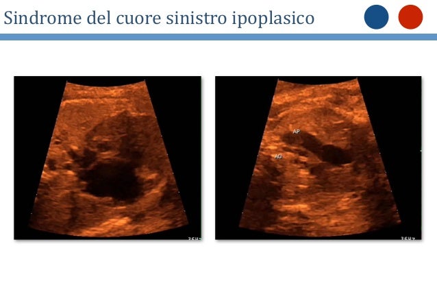 Operazione su un varicosity