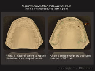 An impression was taken and a cast was made
                with the existing deciduous tooth in place




               ...