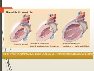 Remodelación ventricular
Corazón normal Hipertrofia ventricular
(insuficiencia cardiaca diastólica)
Dilatación ventricular
(insuficiencia cardiaca sistólica)
HIPERTROFIA ADAPTATIVA DISFUNCIÓN VI HIPERTROFIA DESCOMPENSADA
 
