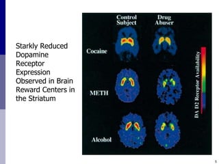 Starkly Reduced
Dopamine
Receptor
Expression
Observed in Brain
Reward Centers in
the Striatum




                    5
 