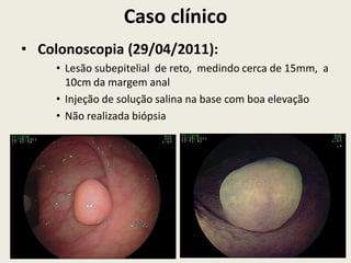 Caso clínico
• Colonoscopia (29/04/2011):
• Lesão subepitelial de reto, medindo cerca de 15mm, a
10cm da margem anal
• Injeção de solução salina na base com boa elevação
• Não realizada biópsia
 