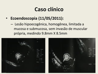 Caso clínico
• Ecoendoscopia (11/05/2011):
– Lesão hipoecogênica, homogênea, limitada a
mucosa e submucosa, sem invasão de muscular
própria, medindo 9.8mm X 8.5mm
 