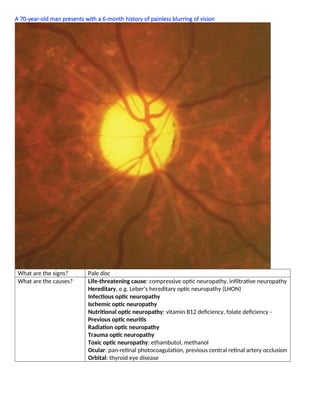 A 70-year-old man presents with a 6-month history of painless blurring of vision
What are the signs? Pale disc
What are the causes? Life-threatening cause: compressive optic neuropathy, inﬁltrative neuropathy
Hereditary, e.g. Leber's hereditary optic neuropathy (LHON)
Infectious optic neuropathy
Ischemic optic neuropathy
Nutritional optic neuropathy: vitamin B12 deﬁciency, folate deﬁciency -
Previous optic neuritis
Radiation optic neuropathy
Trauma optic neuropathy
Toxic optic neuropathy: ethambutol, methanol
Ocular: pan-retinal photocoagulation, previous central retinal artery occlusion
Orbital: thyroid eye disease
 
