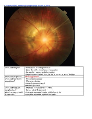 A 45-year-old lady presents with longstanding blurring of vision
What are the signs? - Central core of white glial tissue
- Large disc with a funnel-shaped excavation
- Peripapillary atrophy and pigmentation
- Vessels emerge radially from the disc in "spokes of wheel" fashion
What is the diagnosis? Morning glory disc
What are the systemic
associations?
- Frontonasal dysplasia
- Moyamoya disease
- Neuroﬁbromatosis type 2
- PHACES syndrome
What are the ocular
complications?
- Choroidal neovascularization (CNV)
- Serous retinal detachment
What investigations will
you perform?
- Magnetic resonance imaging (MRI) of the brain
- Magnetic resonance angiography (MRA)
 