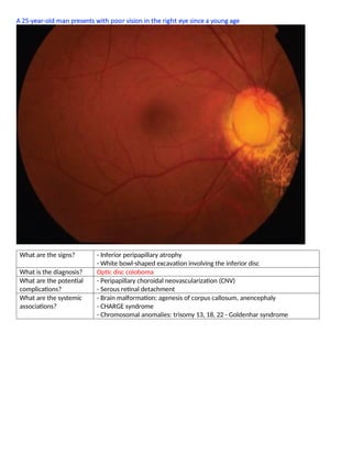 A 25-year-old man presents with poor vision in the right eye since a young age
What are the signs? - Inferior peripapillary atrophy
- White bowl-shaped excavation involving the inferior disc
What is the diagnosis? Optic disc coloboma
What are the potential
complications?
- Peripapillary choroidal neovascularization (CNV)
- Serous retinal detachment
What are the systemic
associations?
- Brain malformation: agenesis of corpus callosum, anencephaly
- CHARGE syndrome
- Chromosomal anomalies: trisomy 13, 18, 22 - Goldenhar syndrome
 