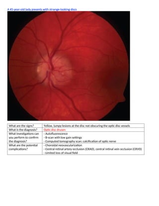 A 45-year-old lady presents with strange-looking discs
What are the signs? Yellow, lumpy lesions at the disc not obscuring the optic disc vessels
What is the diagnosis? Optic disc drusen
What investigations can
you perform to conﬁrm
the diagnosis?
- Autoﬂuorescence
- B-scan with low gain settings
- Computed tomography scan: calciﬁcation of optic nerve
What are the potential
complications?
- Choroidal neovascularization
- Central retinal artery occlusion (CRAO), central retinal vein occlusion (CRVO)
- Limited loss of visual ﬁeld
 