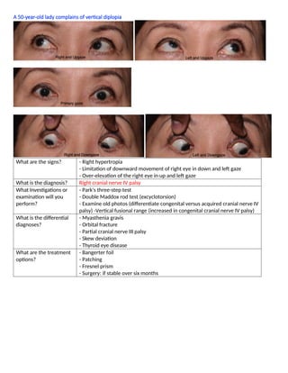 A 50-year-old lady complains of vertical diplopia
What are the signs? - Right hypertropia
- Limitation of downward movement of right eye in down and left gaze
- Over-elevation of the right eye in up and left gaze
What is the diagnosis? Right cranial nerve IV palsy
What Investigations or
examination will you
perform?
- Park's three-step test
- Double Maddox rod test (excyclotorsion)
- Examine old photos (differentiate congenital versus acquired cranial nerve IV
palsy) -Vertical fusional range (increased in congenital cranial nerve IV palsy)
What is the differential
diagnoses?
- Myasthenia gravis
- Orbital fracture
- Partial cranial nerve III palsy
- Skew deviation
- Thyroid eye disease
What are the treatment
options?
- Bangerter foil
- Patching
- Fresnel prism
- Surgery: if stable over six months
 