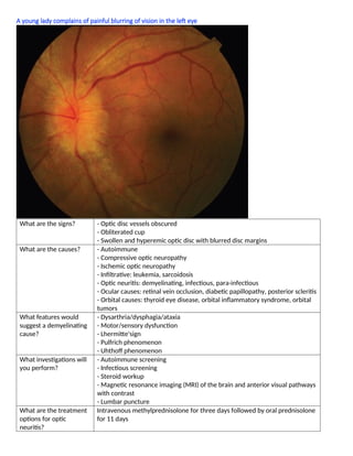 A young lady complains of painful blurring of vision in the left eye
What are the signs? - Optic disc vessels obscured
- Obliterated cup
- Swollen and hyperemic optic disc with blurred disc margins
What are the causes? - Autoimmune
- Compressive optic neuropathy
- Ischemic optic neuropathy
- Inﬁltrative: leukemia, sarcoidosis
- Optic neuritis: demyelinating, infectious, para-infectious
- Ocular causes: retinal vein occlusion, diabetic papillopathy, posterior scleritis
- Orbital causes: thyroid eye disease, orbital inﬂammatory syndrome, orbital
tumors
What features would
suggest a demyelinating
cause?
- Dysarthria/dysphagia/ataxia
- Motor/sensory dysfunction
- Lhermitte'sign
- Pulfrich phenomenon
- Uhthoff phenomenon
What investigations will
you perform?
- Autoimmune screening
- Infectious screening
- Steroid workup
- Magnetic resonance imaging (MRI) of the brain and anterior visual pathways
with contrast
- Lumbar puncture
What are the treatment
options for optic
neuritis?
Intravenous methylprednisolone for three days followed by oral prednisolone
for 11 days
 