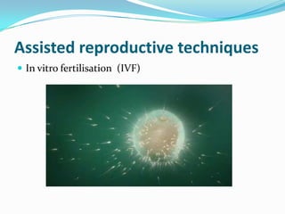Assisted reproductive techniques
 In vitro fertilisation (IVF)
 