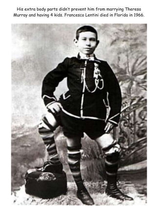 His extra body parts didn’t prevent him from marrying Theresa
Murray and having 4 kids. Francesco Lentini died in Florida in 1966.
 