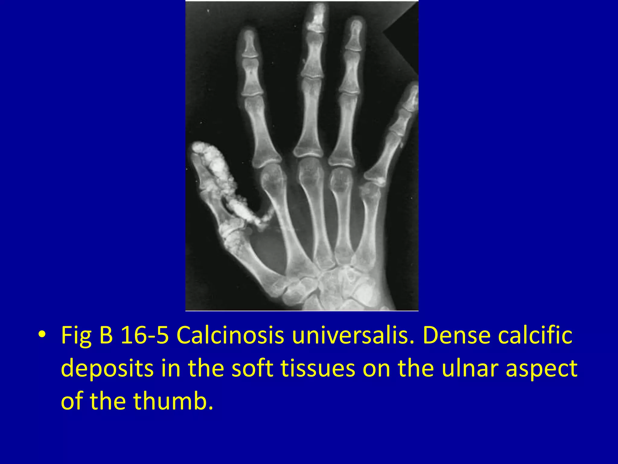 16 periarticular calcification | PPTX