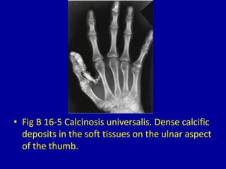 • Fig B 16-5 Calcinosis universalis. Dense calcific
deposits in the soft tissues on the ulnar aspect
of the thumb.