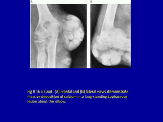 Fig B 16-6 Gout. (A) Frontal and (B) lateral views demonstrate
massive deposition of calcium in a long-standing tophaceous
lesion about the elbow.