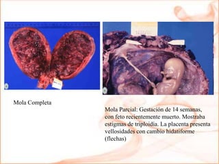 Mola Parcial: Gestación de 14 semanas,
con feto recientemente muerto. Mostraba
estigmas de triploidía. La placenta presenta
vellosidades con cambio hidatiforme
(flechas)
Mola Completa
 