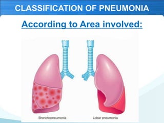 16 Pneumonie.pdf