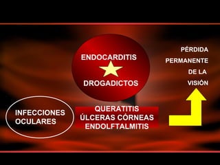 QUERATITIS
ÚLCERAS CÓRNEAS
ENDOLFTALMITIS
ENDOCARDITIS
DROGADICTOS
INFECCIONES
OCULARES
PÉRDIDA
PERMANENTE
DE LA
VISIÓN
 