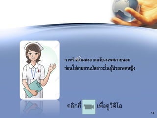 คลิกที่ เพื่อดูวิดิโอ
14
การทาความสะอาดอวัยวะเพศภายนอก
ก่อนใส่สายสวนปัสสาวะในผู้ป่วยเพศหญิง
 