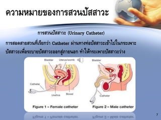 ความหมายของการสวนปัสสาวะ
การสวนปัสสาวะ (Urinary Catheter)
การสอดสายสวนที่เรียกว่า Catheter ผ่านทางท่อปัสสาวะเข้าไปในกระเพาะ
ปัสสาวะเพื่อระบายปัสสาวะออกสู่ภายนอก ทาให้กระเพาะปัสสาวะว่าง
7
 