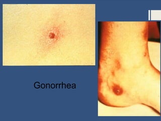 Gonorrhea
 