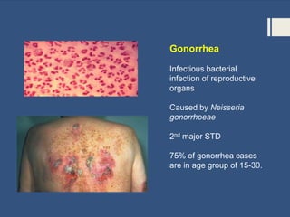 Gonorrhea
Infectious bacterial
infection of reproductive
organs
Caused by Neisseria
gonorrhoeae
2nd major STD
75% of gonorrhea cases
are in age group of 15-30.
 