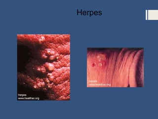 Herpes
 