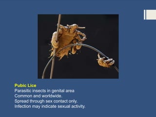 Pubic Lice
Parasitic insects in genital area
Common and worldwide.
Spread through sex contact only.
Infection may indicate sexual activity.
 