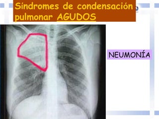 NEUMONÍA
Síndromes de condensación
pulmonar AGUDOS
 