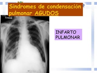 INFARTO
PULMONAR
Síndromes de condensación
pulmonar AGUDOS
 