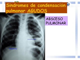 ABSCESO
PULMONAR
Síndromes de condensación
pulmonar AGUDOS
 