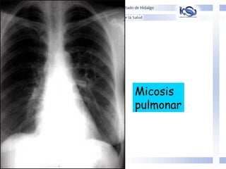 Micosis
pulmonar
 