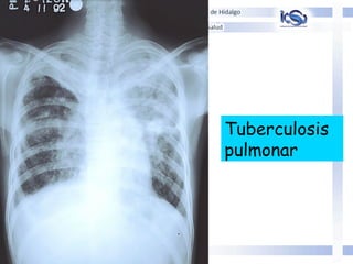 Tuberculosis
pulmonar
 