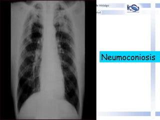 Neumoconiosis
 