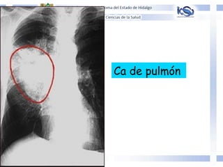 Ca de pulmón
 