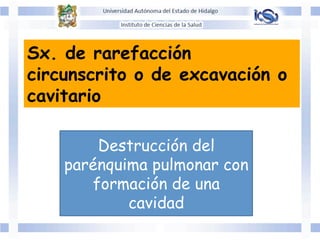 Sx. de rarefacción
circunscrito o de excavación o
cavitario
Destrucción del
parénquima pulmonar con
formación de una
cavidad
 