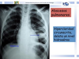 Abscesos
pulmonares
Hiperclaridad
circunscrita,
delata un nivel
hidroaéreo
 