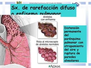 Sx. de rarefacción difuso
o enfisema pulmonar
Distensión
permanente
del
parénquima
pulmonar con
atrapamiento
del aire y
ruptura de
paredes
alveolares
 
