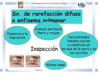 Sx. de rarefacción difuso
o enfisema pulmonar
Inspección
Disneicos a la
Espiración
Cianosis peribucal
Nariz y orejas
Varicosidades
lineales rojizas
o cianóticas en
las alas de la nariz y en
los carrillos
Aleteo nasal
 
