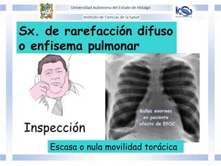 Sx. de rarefacción difuso
o enfisema pulmonar
Escasa o nula movilidad torácica
Inspección
 
