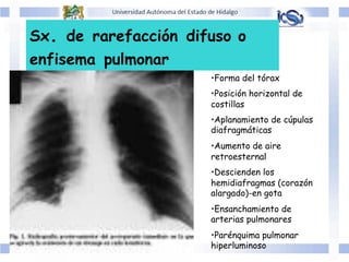 Sx. de rarefacción difuso o
enfisema pulmonar
• Forma del tórax
• Posición horizontal de
costillas
• Aplanamiento de cúpulas
diafragmáticas
• Aumento de aire
retroesternal
• Descienden los
hemidiafragmas (corazón
alargado)-en gota
• Ensanchamiento de
arterias pulmonares
• Parénquima pulmonar
hiperluminoso
 