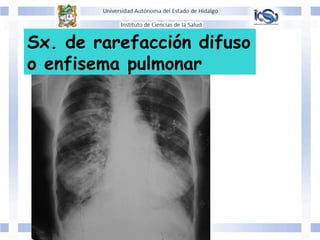 Sx. de rarefacción difuso
o enfisema pulmonar
 