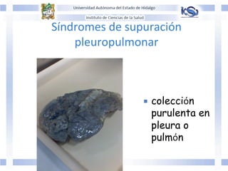 Síndromes	
  de	
  supuración	
  
pleuropulmonar	
  	
  
	
  
	
  
¡  colección
purulenta en
pleura o
pulmón
 