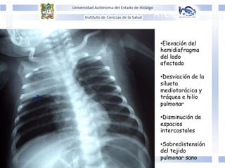 Atelectasia
lobar (superior)
• Elevación del
hemidiafragma
del lado
afectado
• Desviación de la
silueta
mediotorácica y
tráquea e hilio
pulmonar
• Disminución de
espacios
intercostales
• Sobredistensión
del tejido
pulmonar sano
 