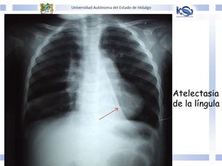 Atelectasia
de la língula
 