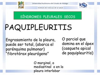 SÍNDROMES PLEURALES SECOS
PAQUIPLEURITIS
Engrosamiento de la pleura,
puede ser total, (abarca el
parénquima pulmonar)
“fibrotórax pleurógeno”
O parcial que
domina en el ápex
(casquete apical
de paquipleuritis)
O marginal, o
mediastinal o en la
pleura interlobar
 