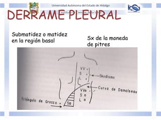 DERRAME PLEURAL
Submatidez o matidez
en la región basal Sx de la moneda
de pitres
 