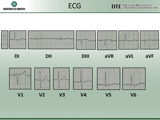 ECG

DI

V1

DII

V2

DIII

V3

aVR

V4

V5

aVL

V6

aVF

 