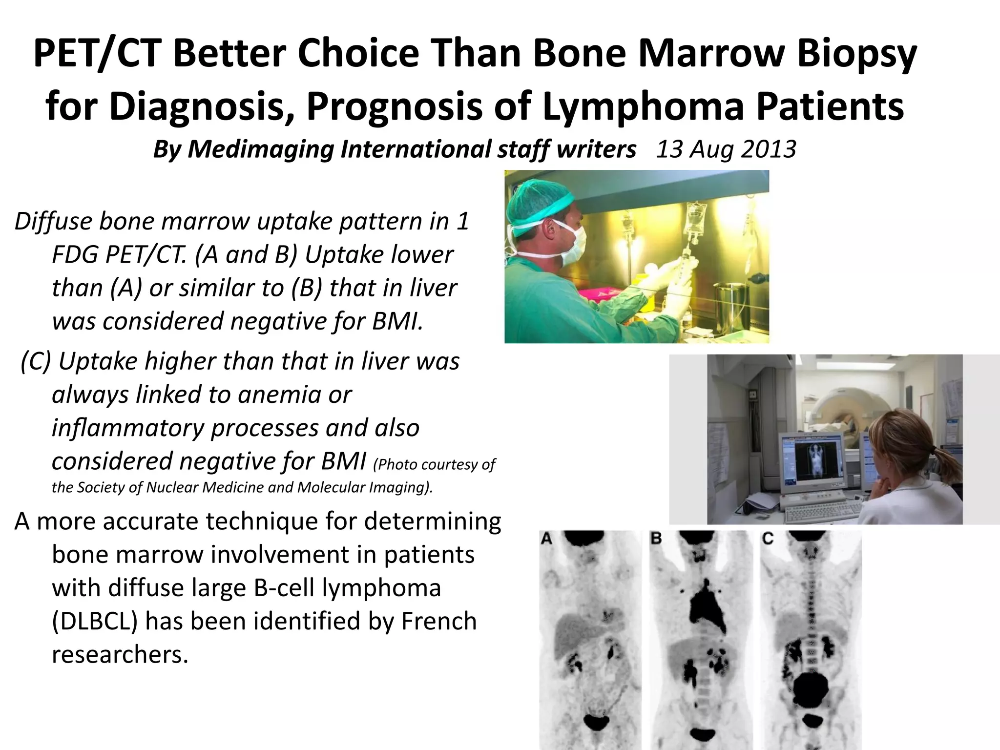 PET/CT Better Choice Than Bone Marrow Biopsy 
for Diagnosis, Prognosis of Lymphoma Patients  
By Medimaging International staff writers   13 Aug 2013
Diffuse bone marrow uptake pattern in 18F‐
FDG PET/CT. (A and B) Uptake lower 
than (A) or similar to (B) that in liver 
was considered negative for BMI.
(C) Uptake higher than that in liver was 
always linked to anemia or 
inﬂammatory processes and also 
considered negative for BMI (Photo courtesy of 
the Society of Nuclear Medicine and Molecular Imaging).
A more accurate technique for determining 
bone marrow involvement in patients 
with diffuse large B‐cell lymphoma 
(DLBCL) has been identified by French 
researchers.
 