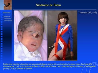 Síndrome de Patau
Trisomía (47, +13)
Mutaciones
Genómicas
Poliploidía
Aneuploidía
Existen otras trisomías autosómicas con las que puede llegar a nacer el niño y vivir durante unos pocos meses. Es el caso de la
trisomía del par 13 (47, +13) o síndrome de Patau (1/12000, sólo el 5% vive 1 año, 1 sólo caso llegó a los 33 años), y la trisomía del
par 18 (47, +18), o síndrome de Edwards.
 