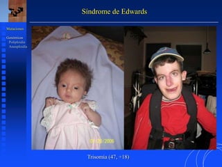 Síndrome de Edwards
Trisomía (47, +18)
Mutaciones
Genómicas
Poliploidía
Aneuploidía
 